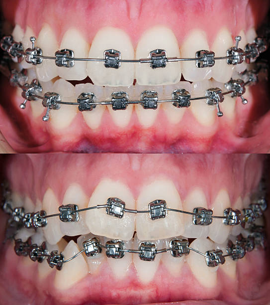 Clear aligners